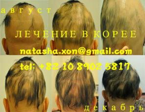 Лечение облысения стволовыми клетками в Корее