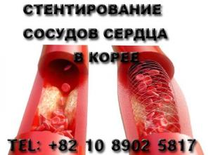 Стентирование сосудов сердца в корее
