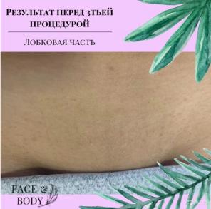 Лазерная эпиляция недорого