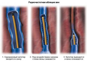 Радиочастотная абляция