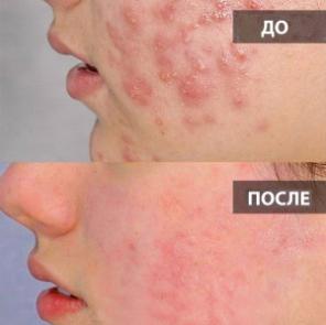 Катушки Мишина с генератором