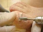 удаление грубых, деформированных, вросших, грибковых ногтей и мозолей