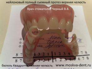 Съемное протезирование бюгеля Квадротти