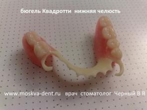 Съемное протезирование бюгеля Квадротти