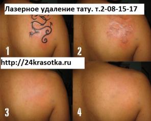 Удаление татуировок в Красноярске
