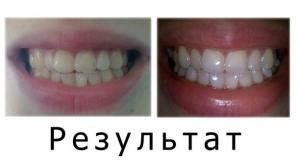Отбеливающие полоски для зубов