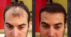 Средство для роста волос BeautyHairFull + подарок