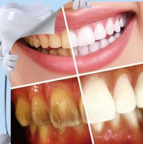 Средство для отбеливания зубов: TEETH CLEANING KIT