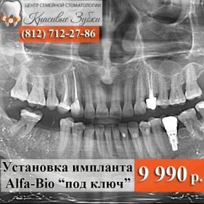 Установка имплантата Alfa-bio 9990 руб. под ключ