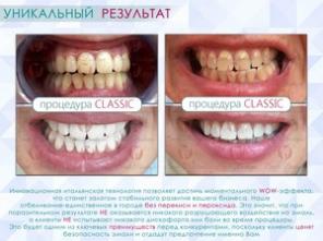 Студия косметического экспресс-отбеливания зубов
