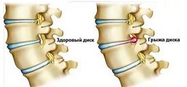 Лечение грыжи
