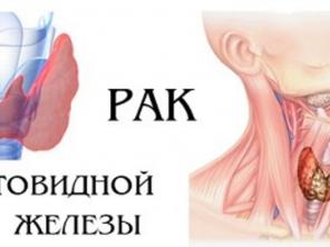 Безоперационное лечение опухоли щитовидки и иных